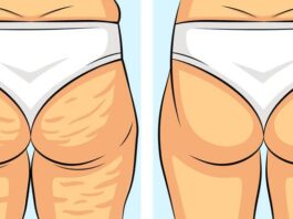 Ягодицы (попа) до и после похудения