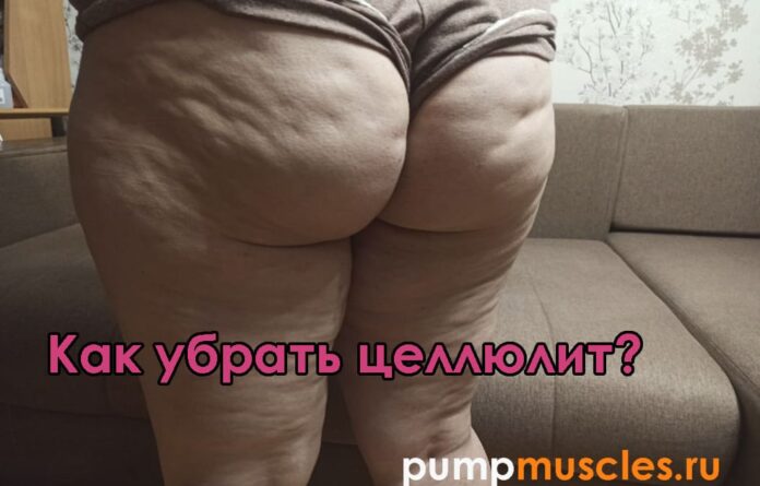 как убрать целлюлит с бедер Целлюлит на ягодицах