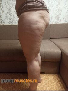Целлюлит на бедрах